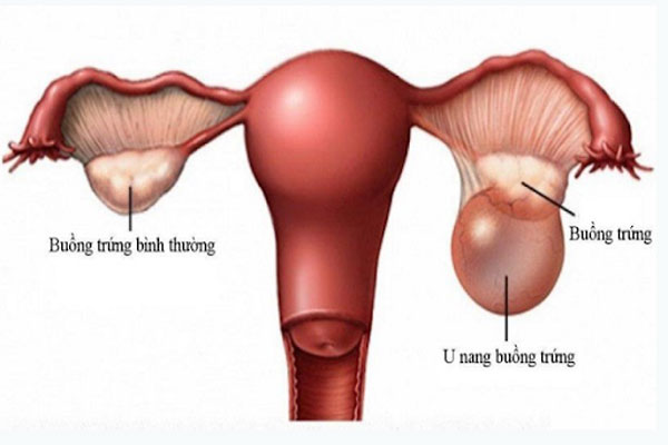 U nang buồng trứng là một trong những bệnh phụ khoa thường gặp nhất ở phụ nữ trong độ tuổi sinh sản